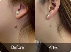 Skincell Mole and Skin Tag Corrector Review Guide