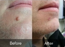 Best Mole and Skin Tag Serum Repair Prices