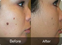 Skin Tag and Mole Removal Costs