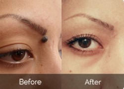 Affordable Mole and Skin Tag Treatment