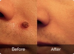 Top Rated Overnight Skin Tag Remover