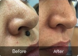Skincell Mole and Skin Tag Corrector Review Guide