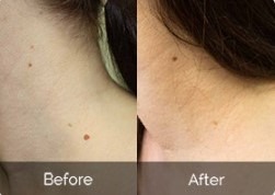 Affordable Mole and Skin Tag Treatment