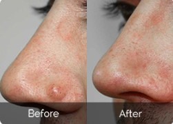 Top Rated Overnight Skin Tag Remover