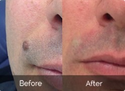Skincell Mole and Skin Tag Corrector Review Guide