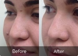 Top Rated Overnight Skin Tag Remover