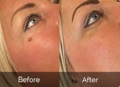Skin Tag and Mole Removal Costs